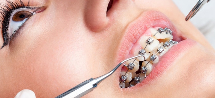 تاثیر دندان عقل بر ارتودنسی