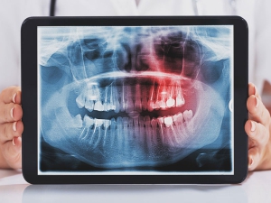 تاثیر دندان عقل بر ارتودنسی