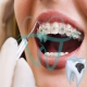 ترمیم دندان حین ارتودنسی