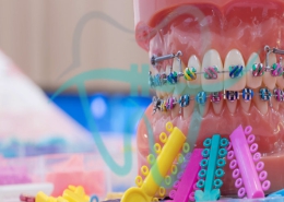ارتودنسی رنگی دندان