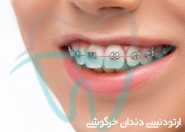 ارتودنسی دندان خرگوشی اصفهان